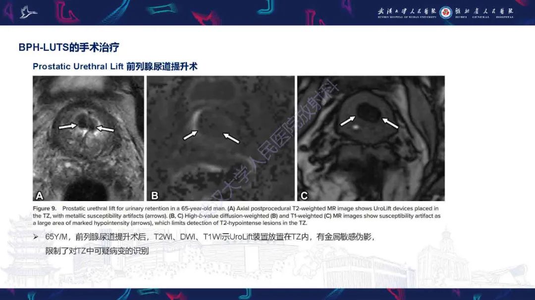 影像PPT - 【PPT】良性前列腺增生治疗前后MRI评估-36