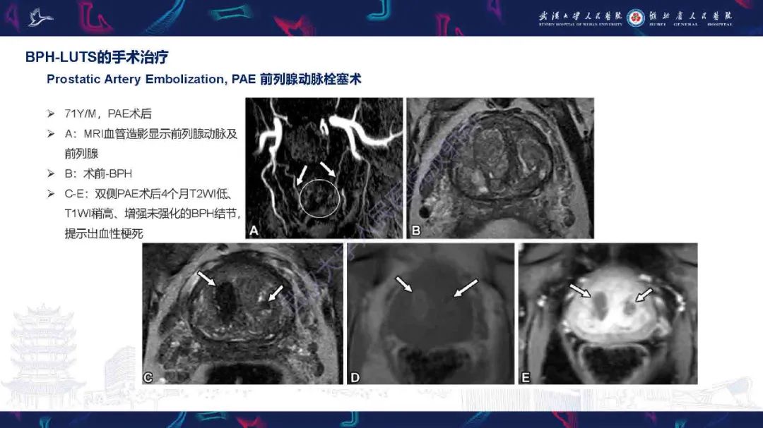 影像PPT - 【PPT】良性前列腺增生治疗前后MRI评估-39