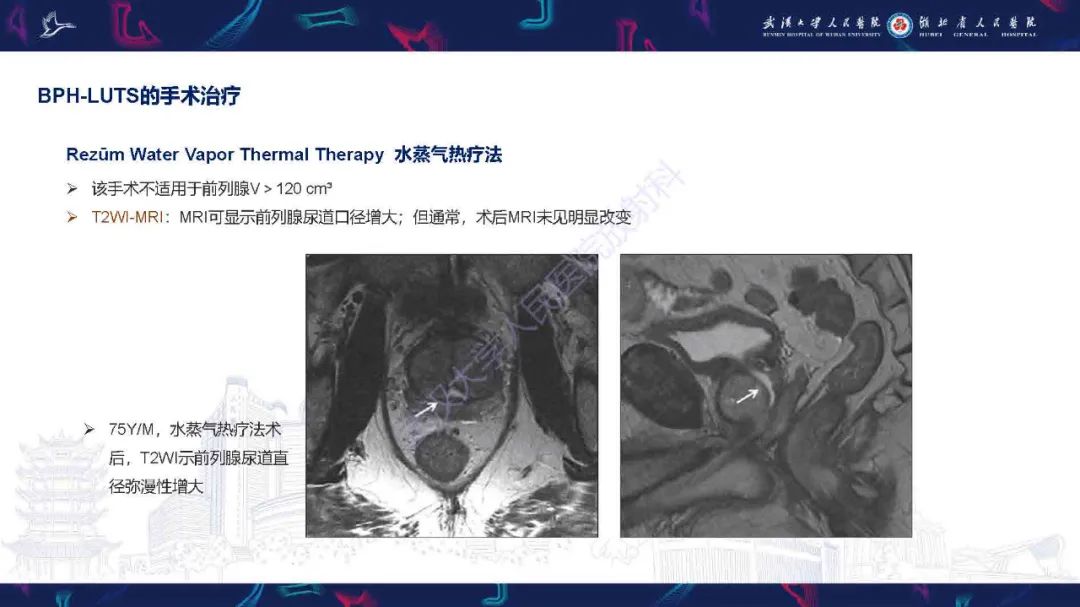 影像PPT - 【PPT】良性前列腺增生治疗前后MRI评估-41