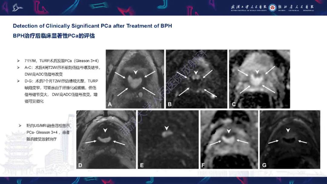 影像PPT - 【PPT】良性前列腺增生治疗前后MRI评估-46