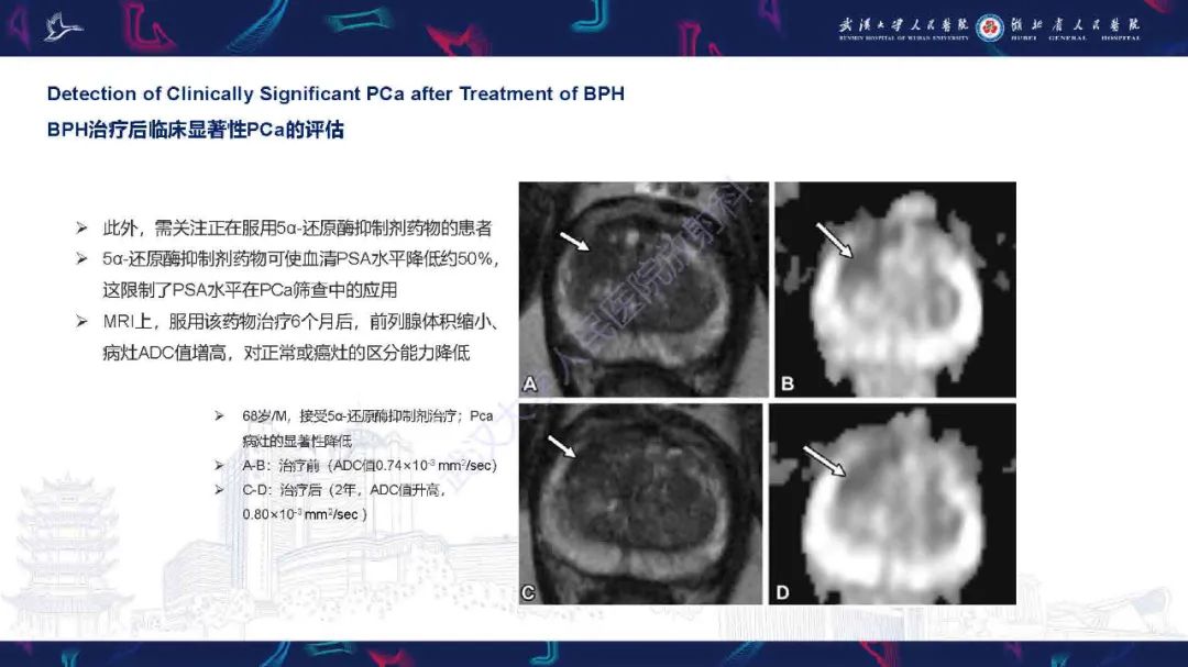 影像PPT - 【PPT】良性前列腺增生治疗前后MRI评估-47