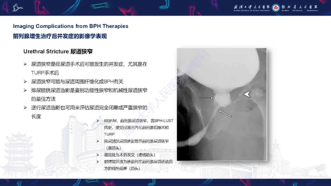 影像PPT - 【PPT】良性前列腺增生治疗前后MRI评估-50