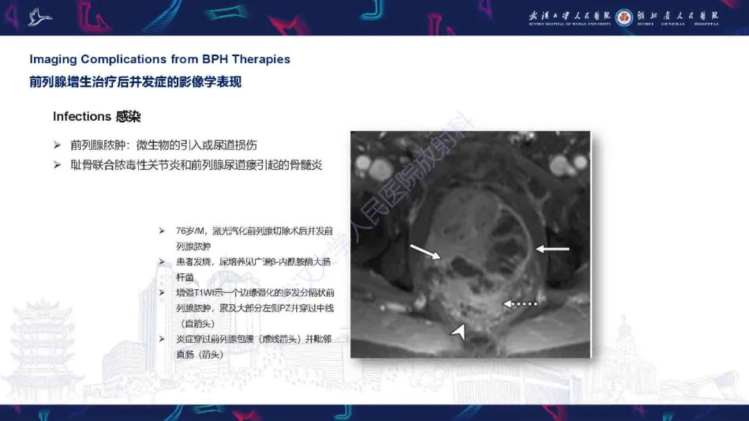 影像PPT - 【PPT】良性前列腺增生治疗前后MRI评估-51