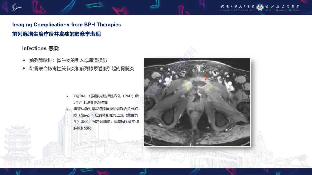 影像PPT - 【PPT】良性前列腺增生治疗前后MRI评估-52