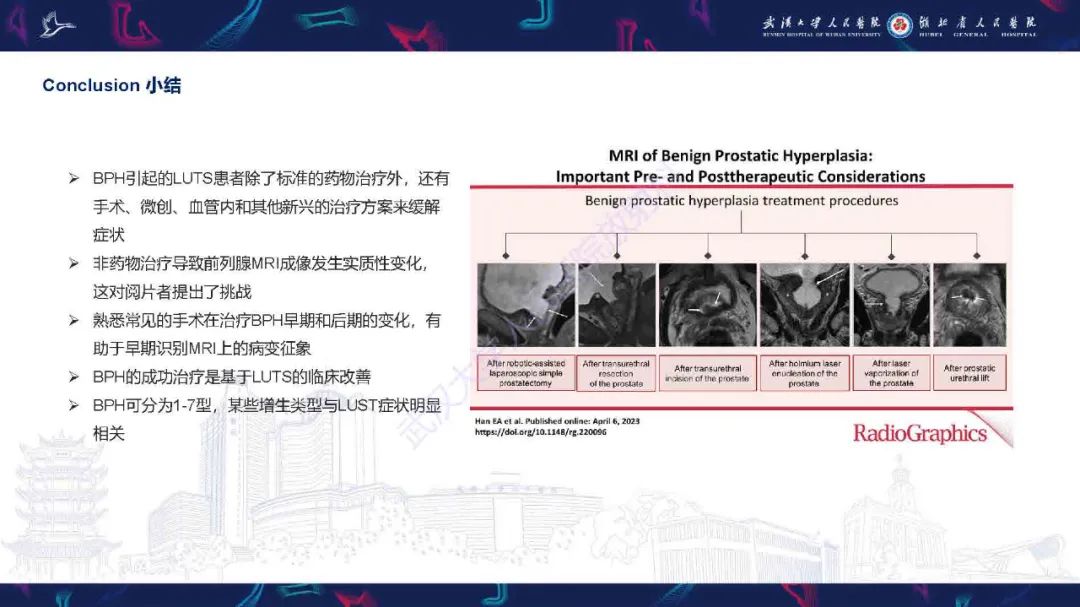 影像PPT - 【PPT】良性前列腺增生治疗前后MRI评估-54