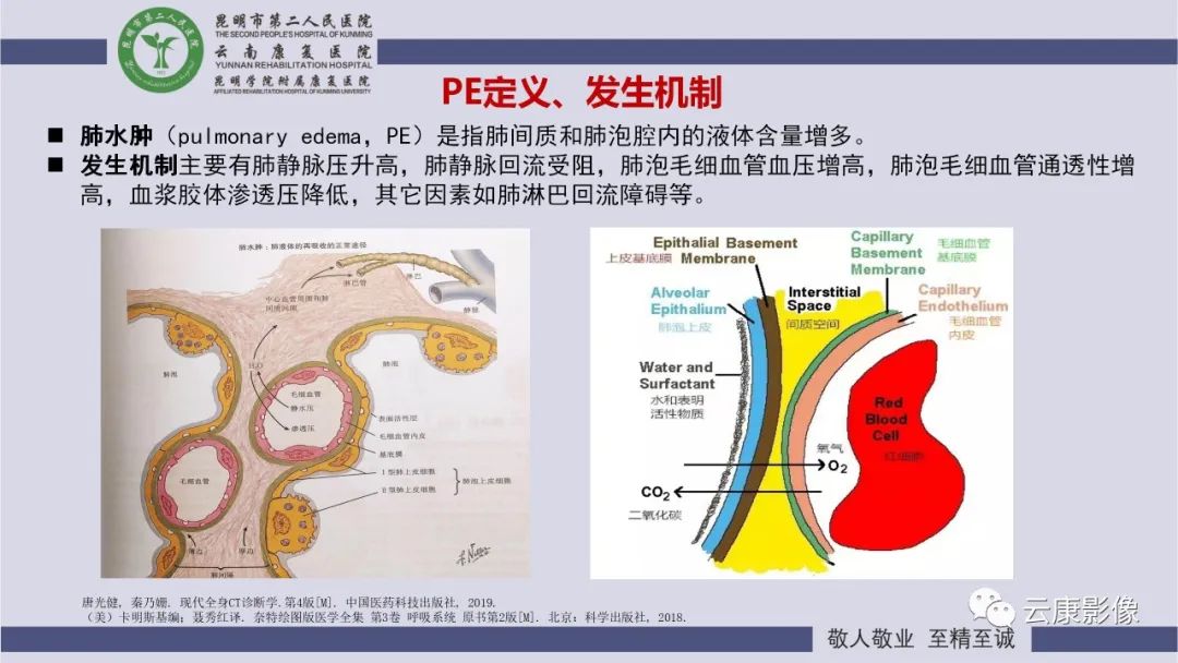 影像PPT - 【PPT】肺水肿的影像诊断-4