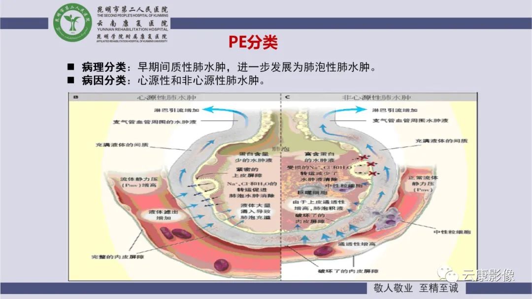 影像PPT - 【PPT】肺水肿的影像诊断-5