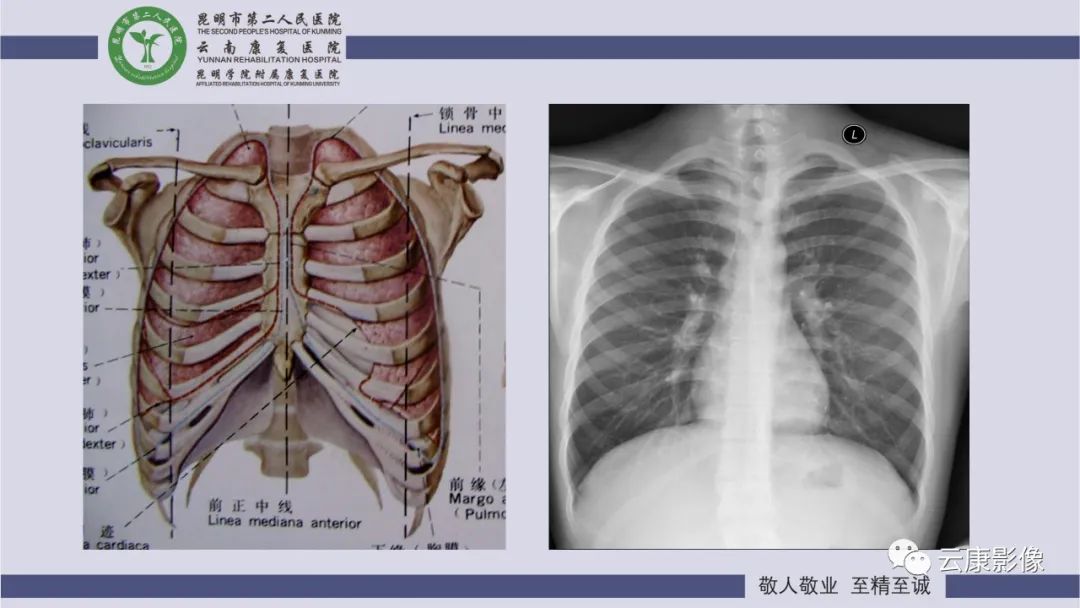 影像PPT - 【PPT】肺水肿的影像诊断-9