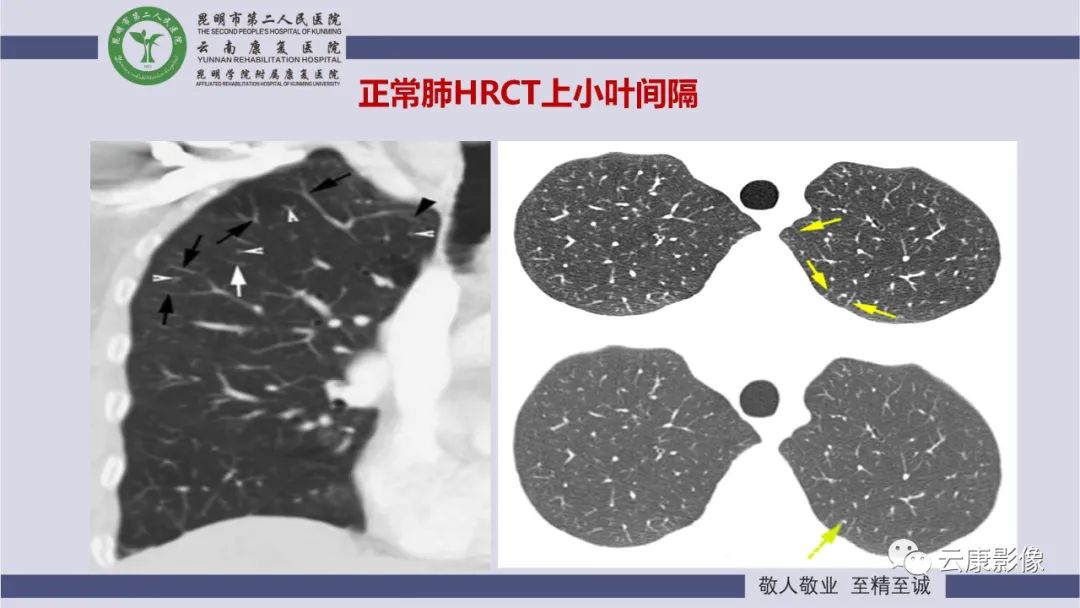 影像PPT - 【PPT】肺水肿的影像诊断-11