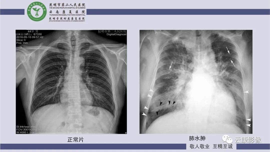影像PPT - 【PPT】肺水肿的影像诊断-13