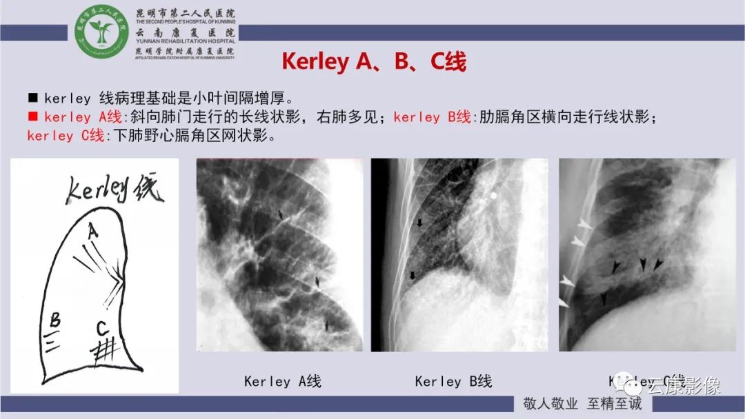 影像PPT - 【PPT】肺水肿的影像诊断-14