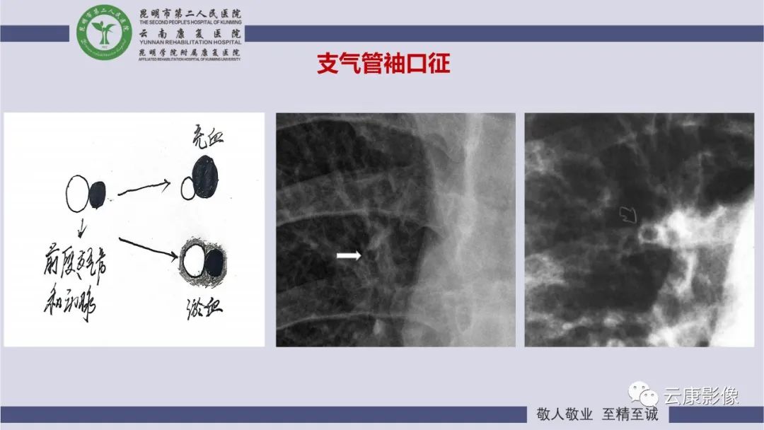 影像PPT - 【PPT】肺水肿的影像诊断-15