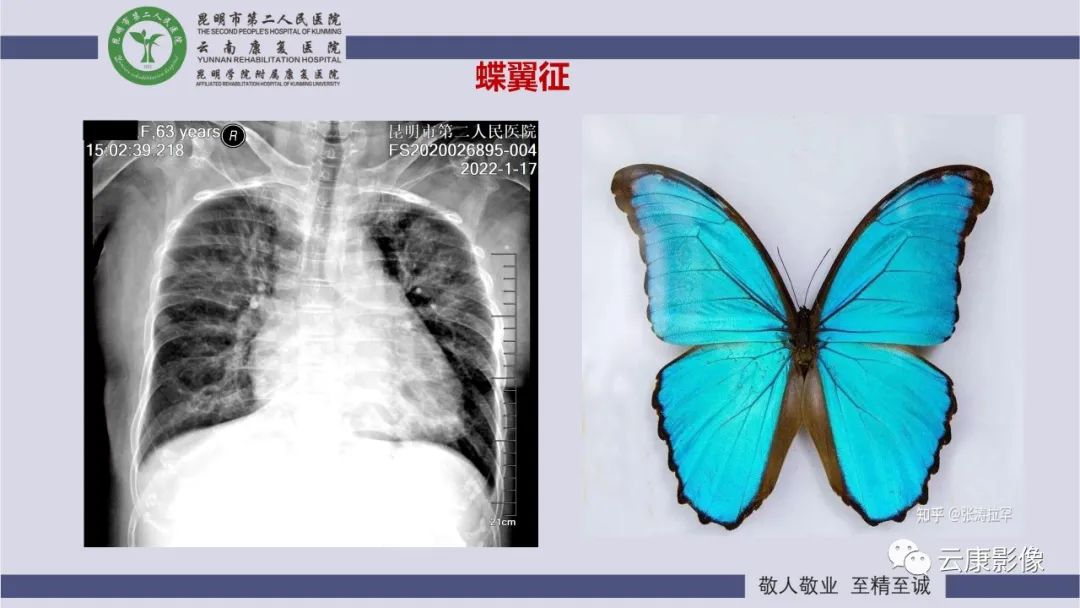 影像PPT - 【PPT】肺水肿的影像诊断-16