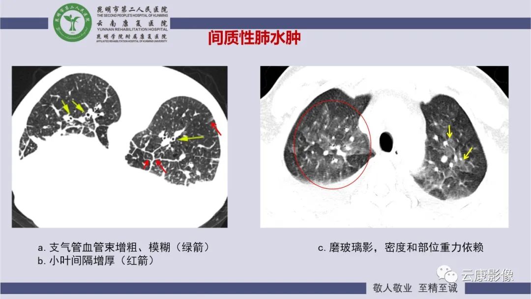 影像PPT - 【PPT】肺水肿的影像诊断-18