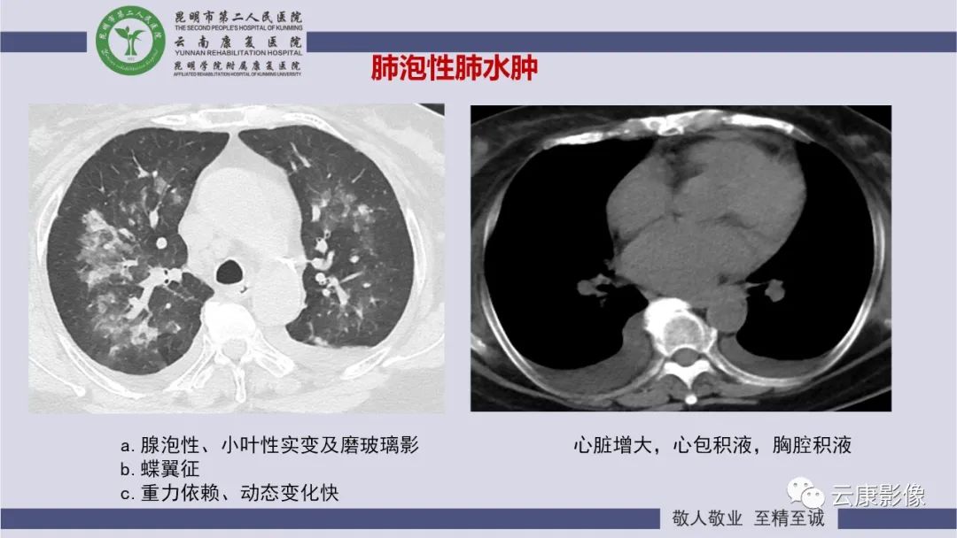 影像PPT - 【PPT】肺水肿的影像诊断-19