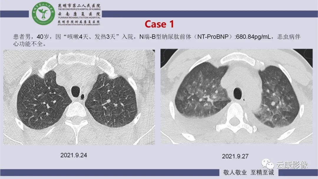 影像PPT - 【PPT】肺水肿的影像诊断-20