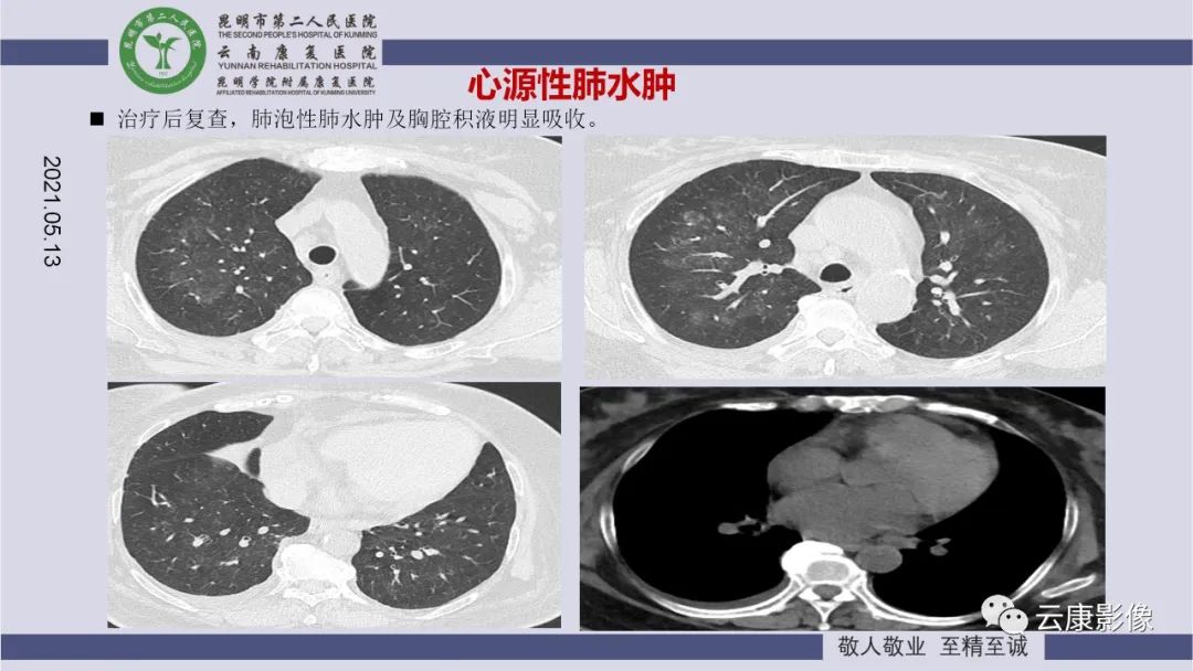 影像PPT - 【PPT】肺水肿的影像诊断-24