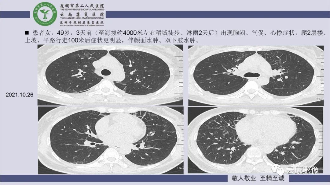 影像PPT - 【PPT】肺水肿的影像诊断-26