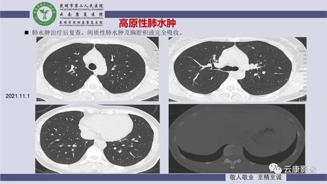 影像PPT - 【PPT】肺水肿的影像诊断-28