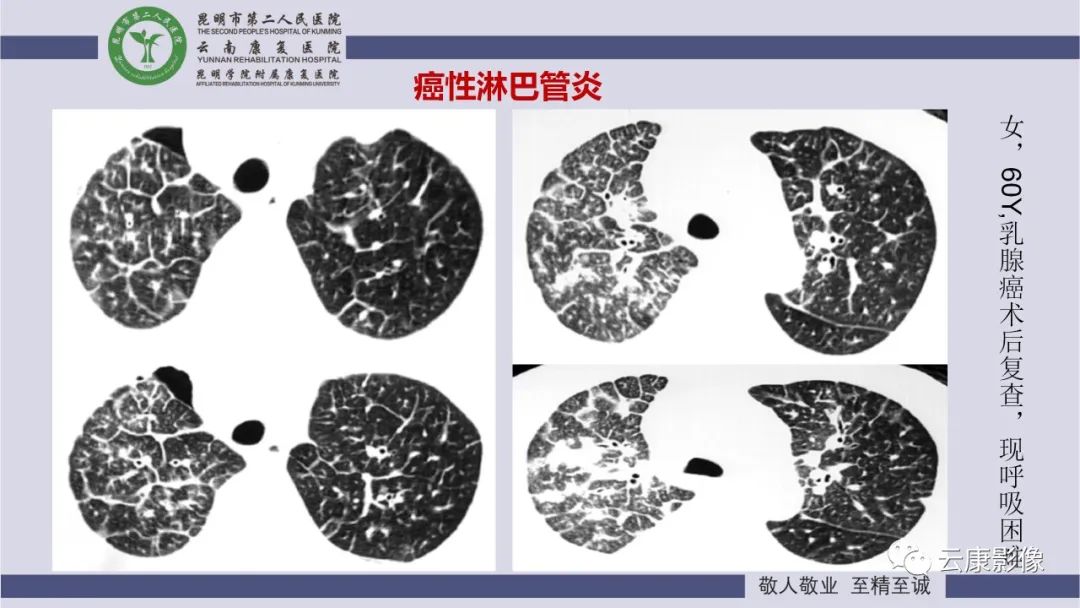 影像PPT - 【PPT】肺水肿的影像诊断-31