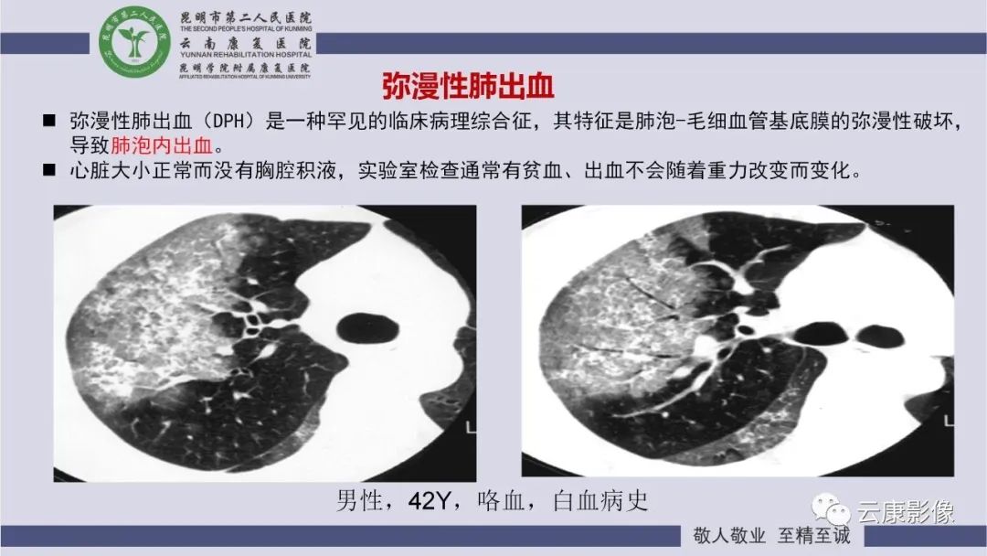 影像PPT - 【PPT】肺水肿的影像诊断-32