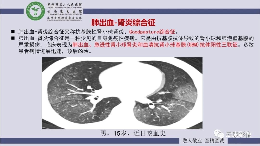 影像PPT - 【PPT】肺水肿的影像诊断-33