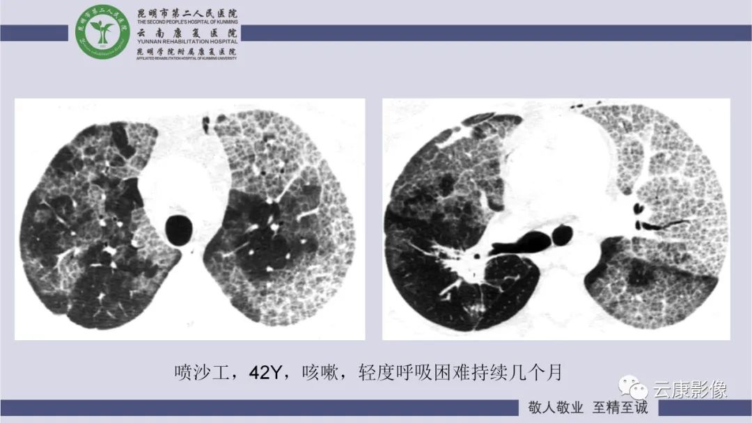 影像PPT - 【PPT】肺水肿的影像诊断-35