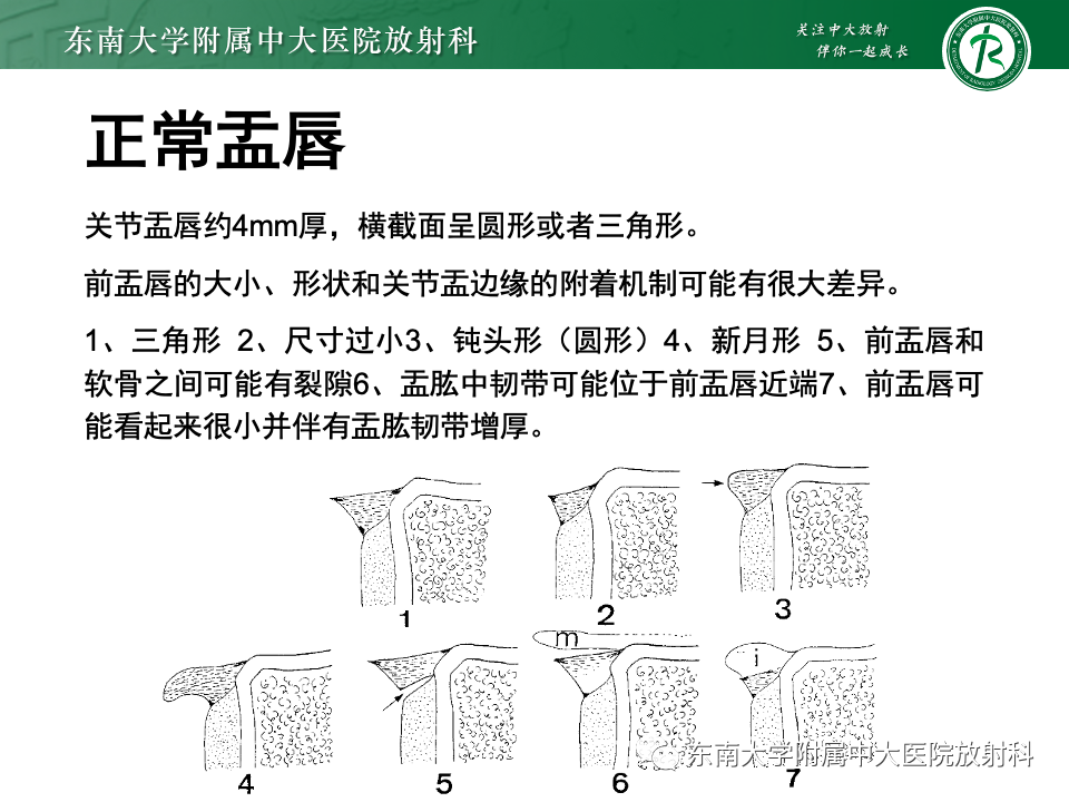 影像PPT - 【PPT】肩关节盂唇损伤-11