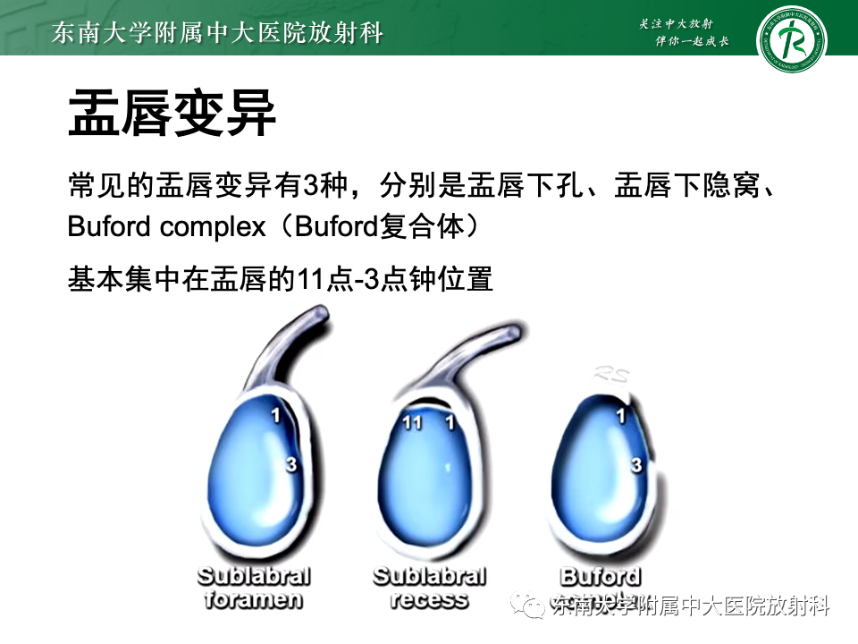影像PPT - 【PPT】肩关节盂唇损伤-13
