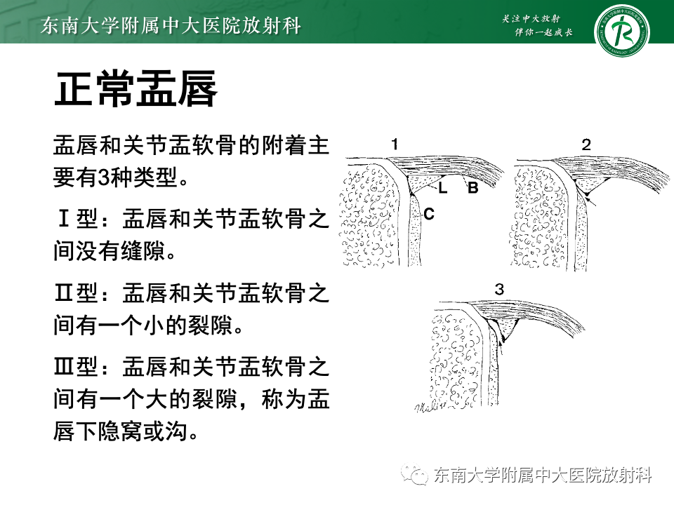 影像PPT - 【PPT】肩关节盂唇损伤-12