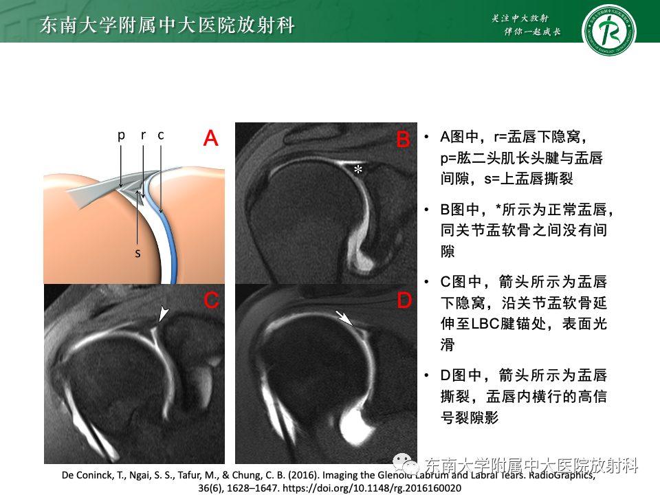 影像PPT - 【PPT】肩关节盂唇损伤-15