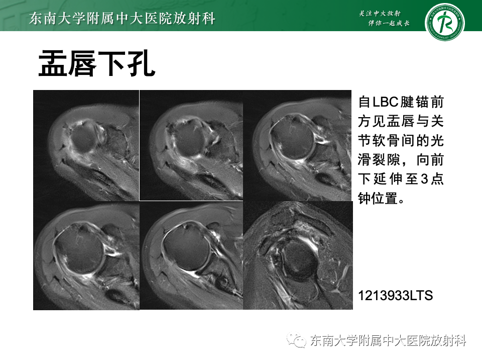 影像PPT - 【PPT】肩关节盂唇损伤-16