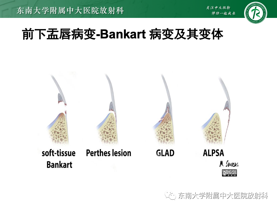 影像PPT - 【PPT】肩关节盂唇损伤-22
