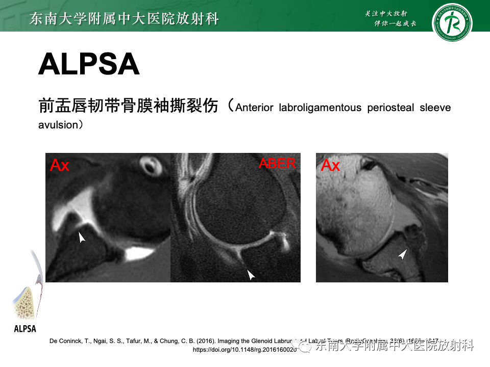 影像PPT - 【PPT】肩关节盂唇损伤-25
