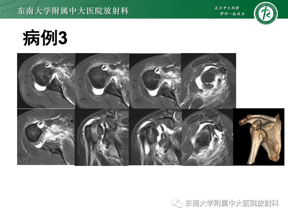 影像PPT - 【PPT】肩关节盂唇损伤-30