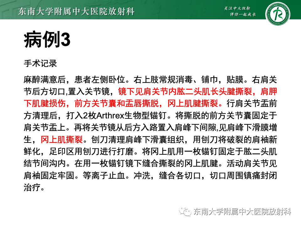 影像PPT - 【PPT】肩关节盂唇损伤-31