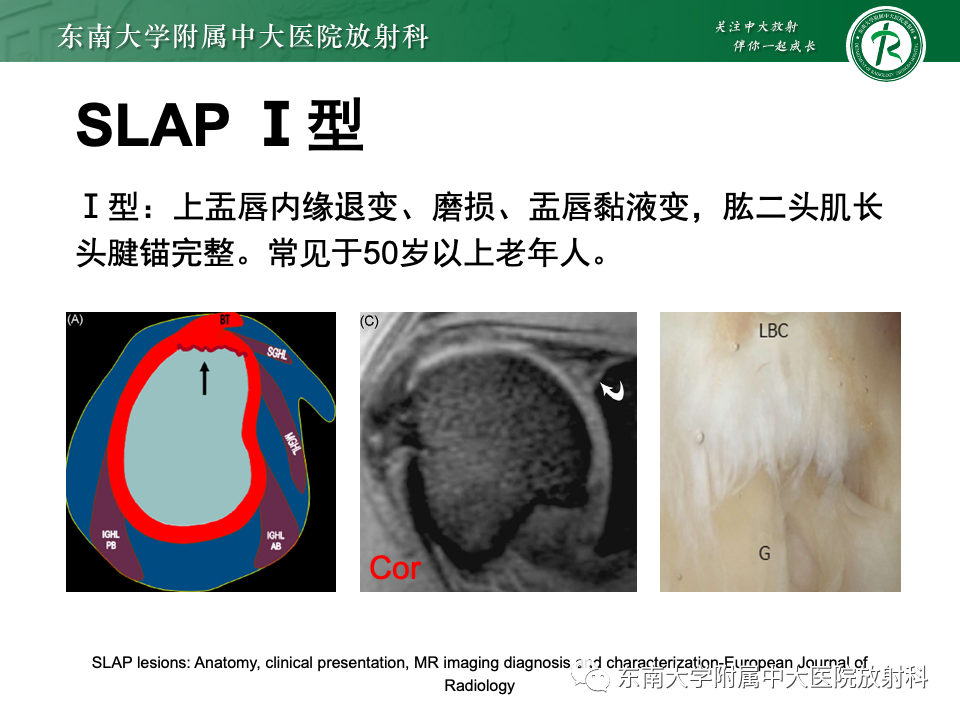 影像PPT - 【PPT】肩关节盂唇损伤-35