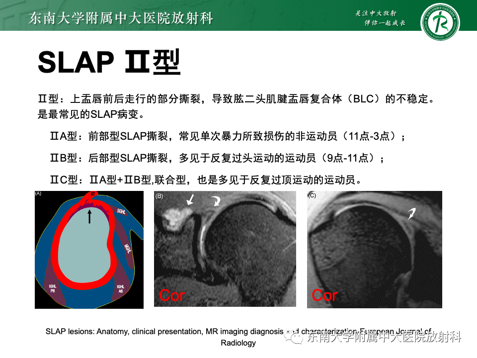 影像PPT - 【PPT】肩关节盂唇损伤-36