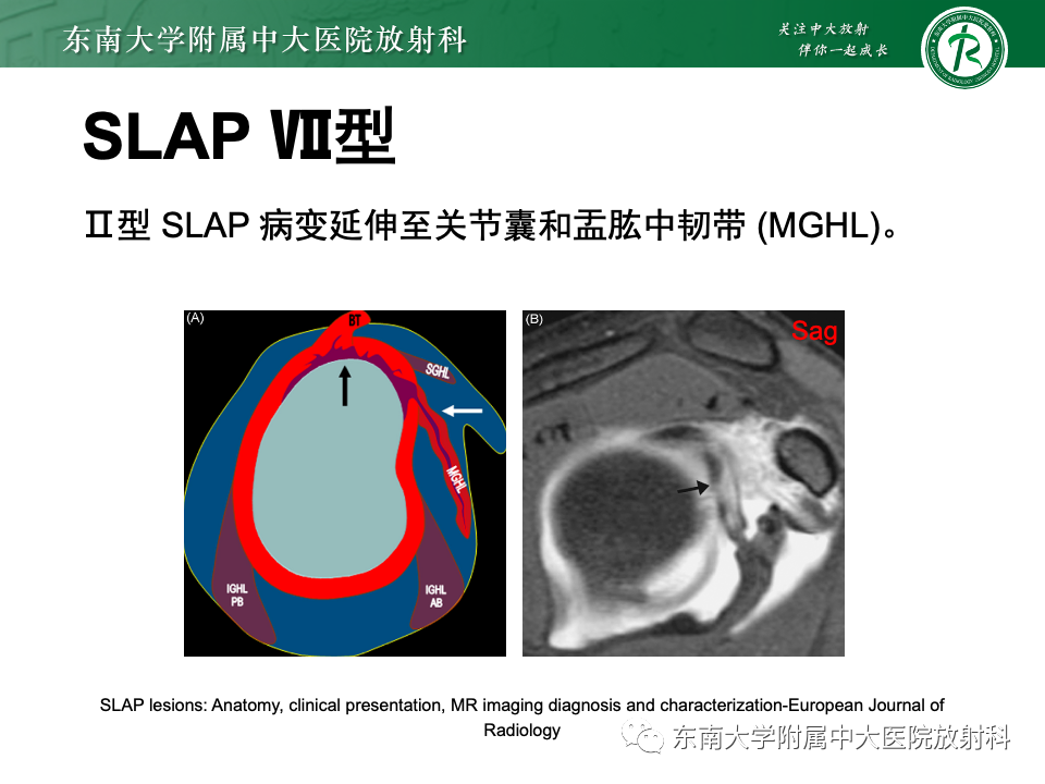 影像PPT - 【PPT】肩关节盂唇损伤-41