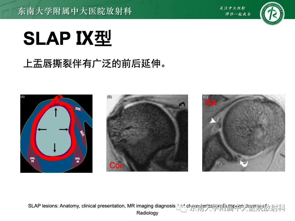 影像PPT - 【PPT】肩关节盂唇损伤-43