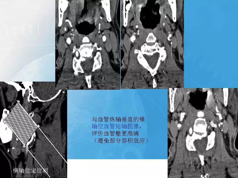 影像PPT - 【PPT】颈动脉CTA及MRA评价-8