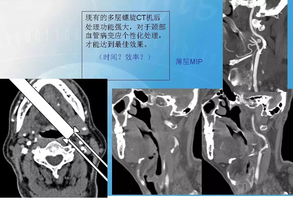 影像PPT - 【PPT】颈动脉CTA及MRA评价-9