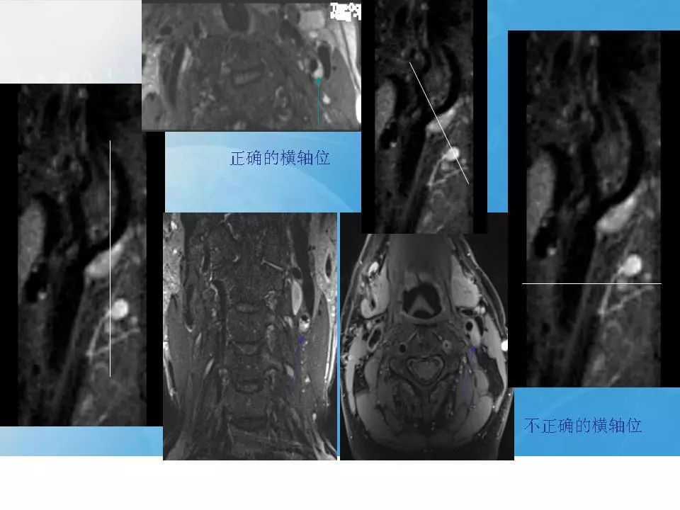 影像PPT - 【PPT】颈动脉CTA及MRA评价-11