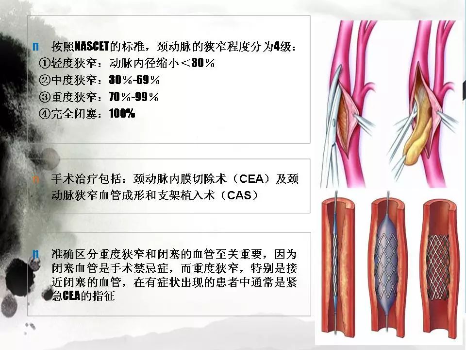 影像PPT - 【PPT】颈动脉CTA及MRA评价-17