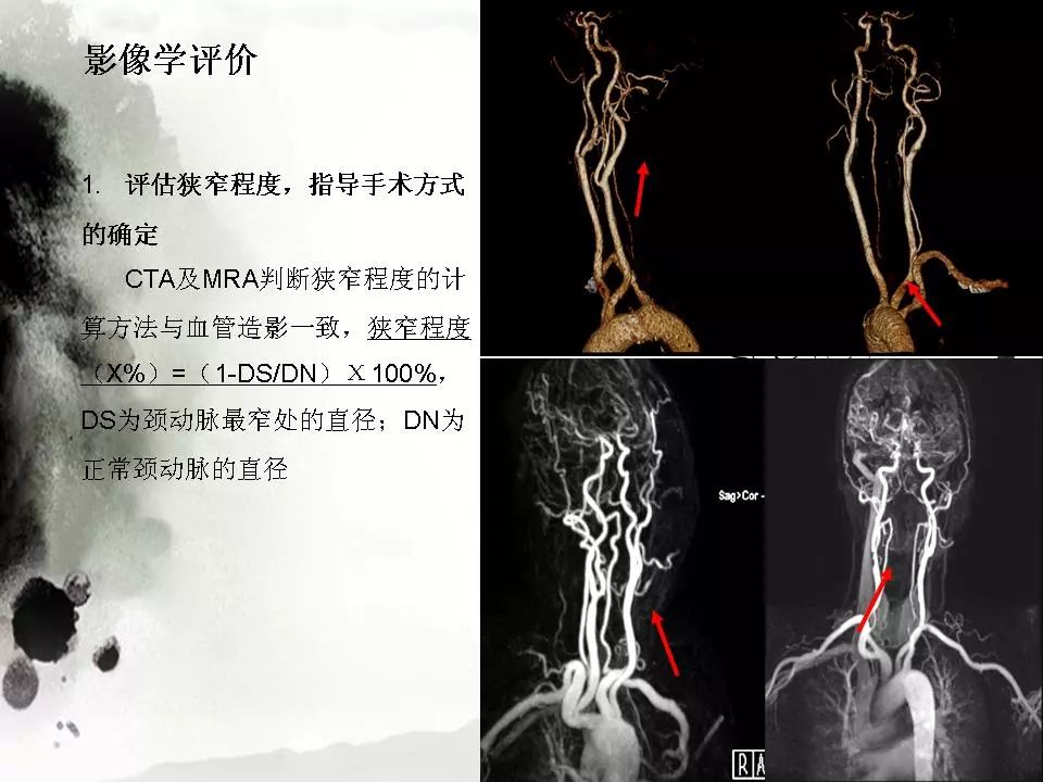 影像PPT - 【PPT】颈动脉CTA及MRA评价-18