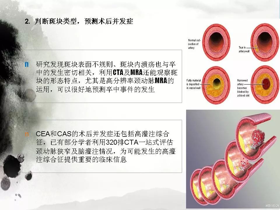 影像PPT - 【PPT】颈动脉CTA及MRA评价-21