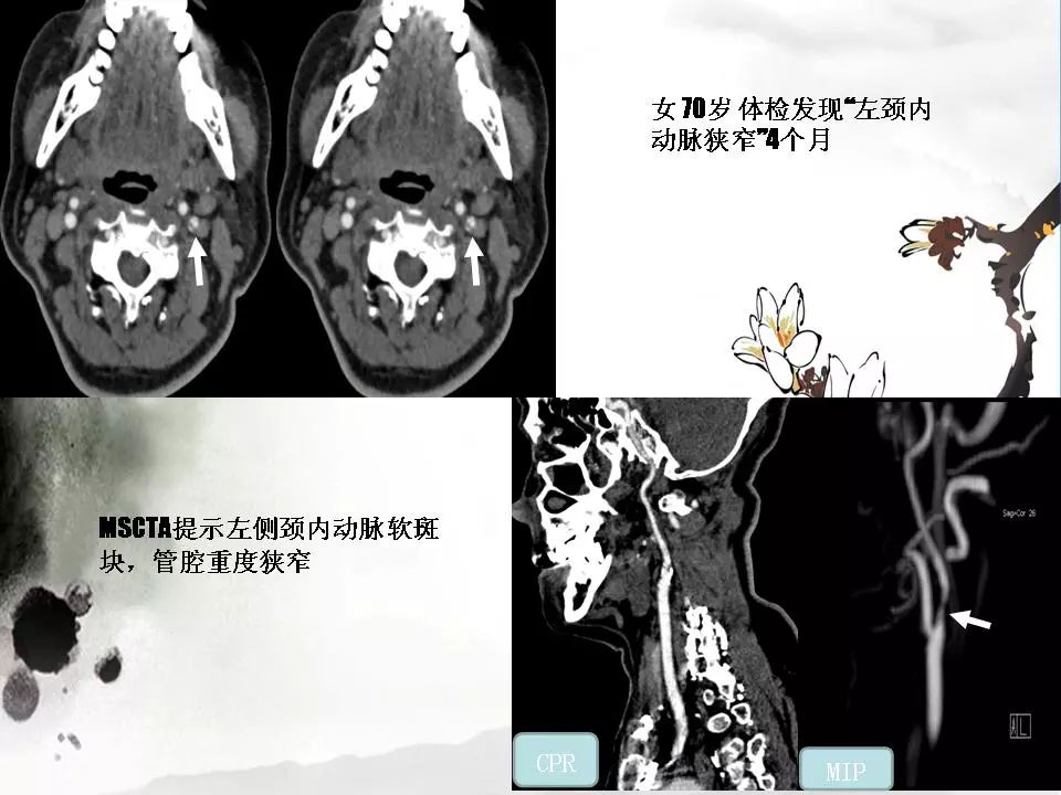 影像PPT - 【PPT】颈动脉CTA及MRA评价-23