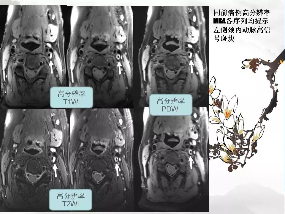 影像PPT - 【PPT】颈动脉CTA及MRA评价-24