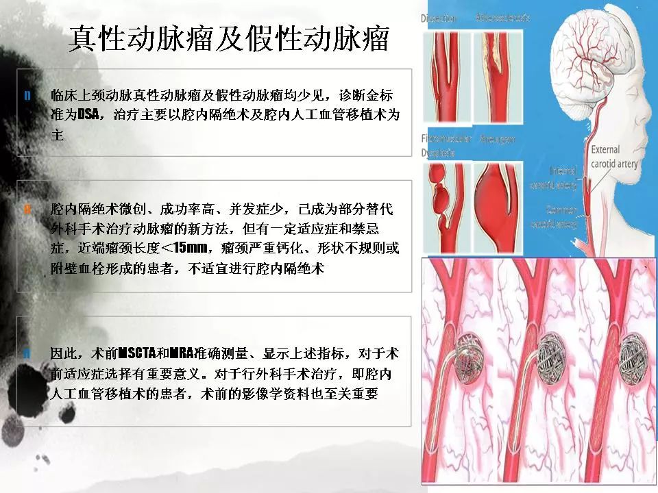 影像PPT - 【PPT】颈动脉CTA及MRA评价-26