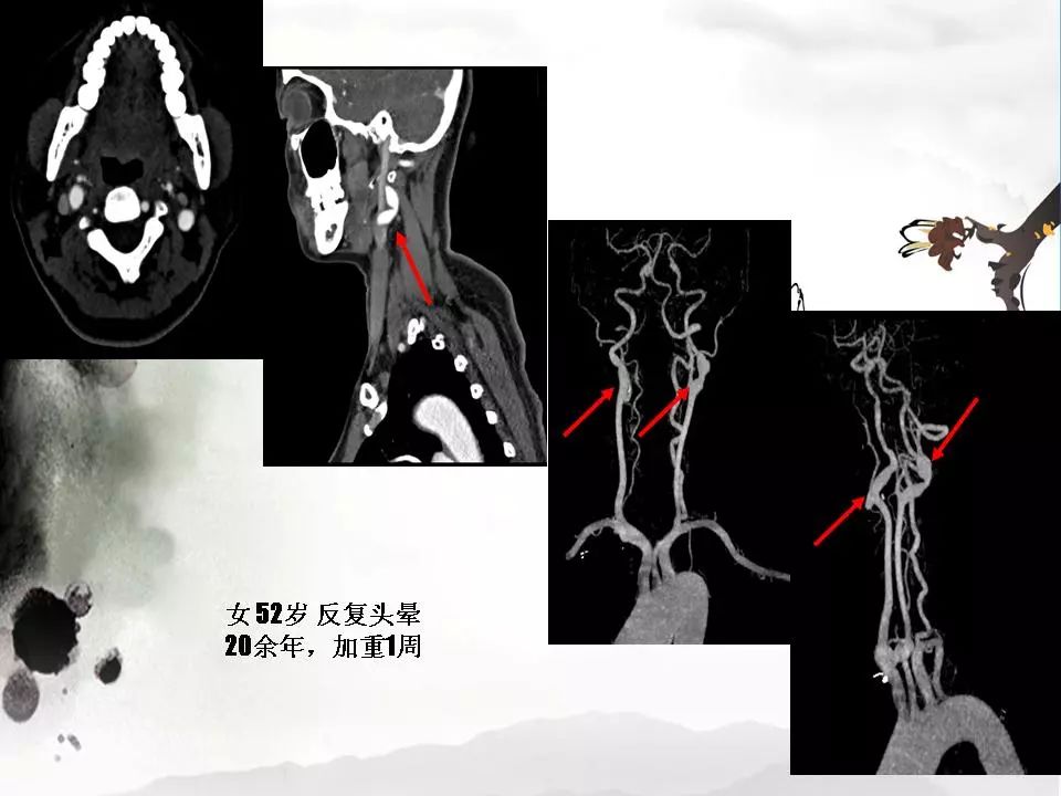 影像PPT - 【PPT】颈动脉CTA及MRA评价-27